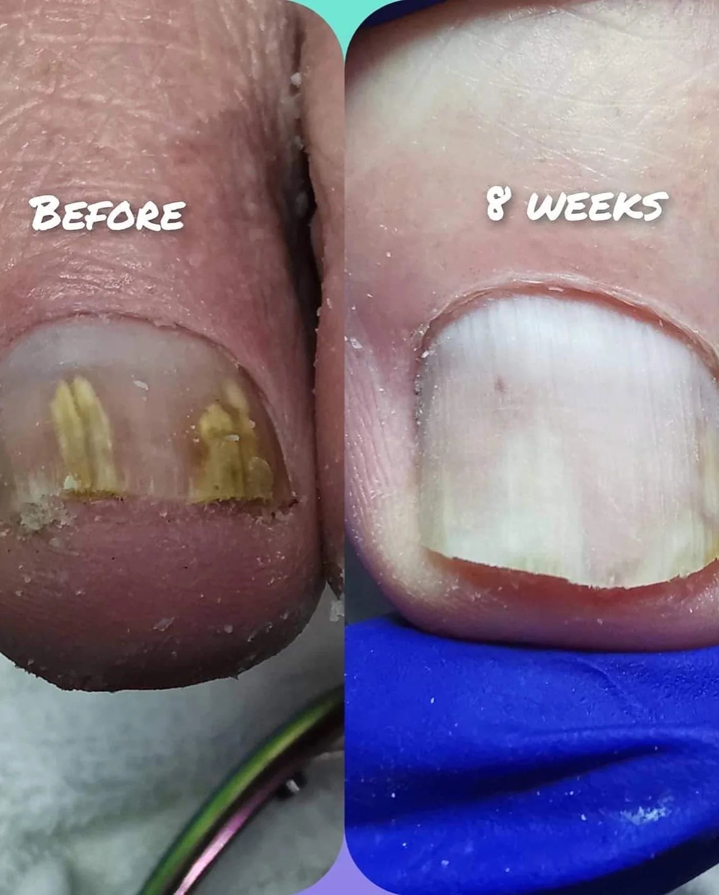 Toe Fungus Solution