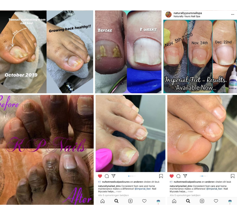 Toe Fungus Solution
