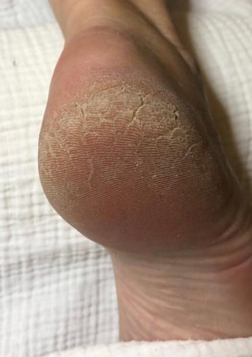 Check the status of the cracked skin