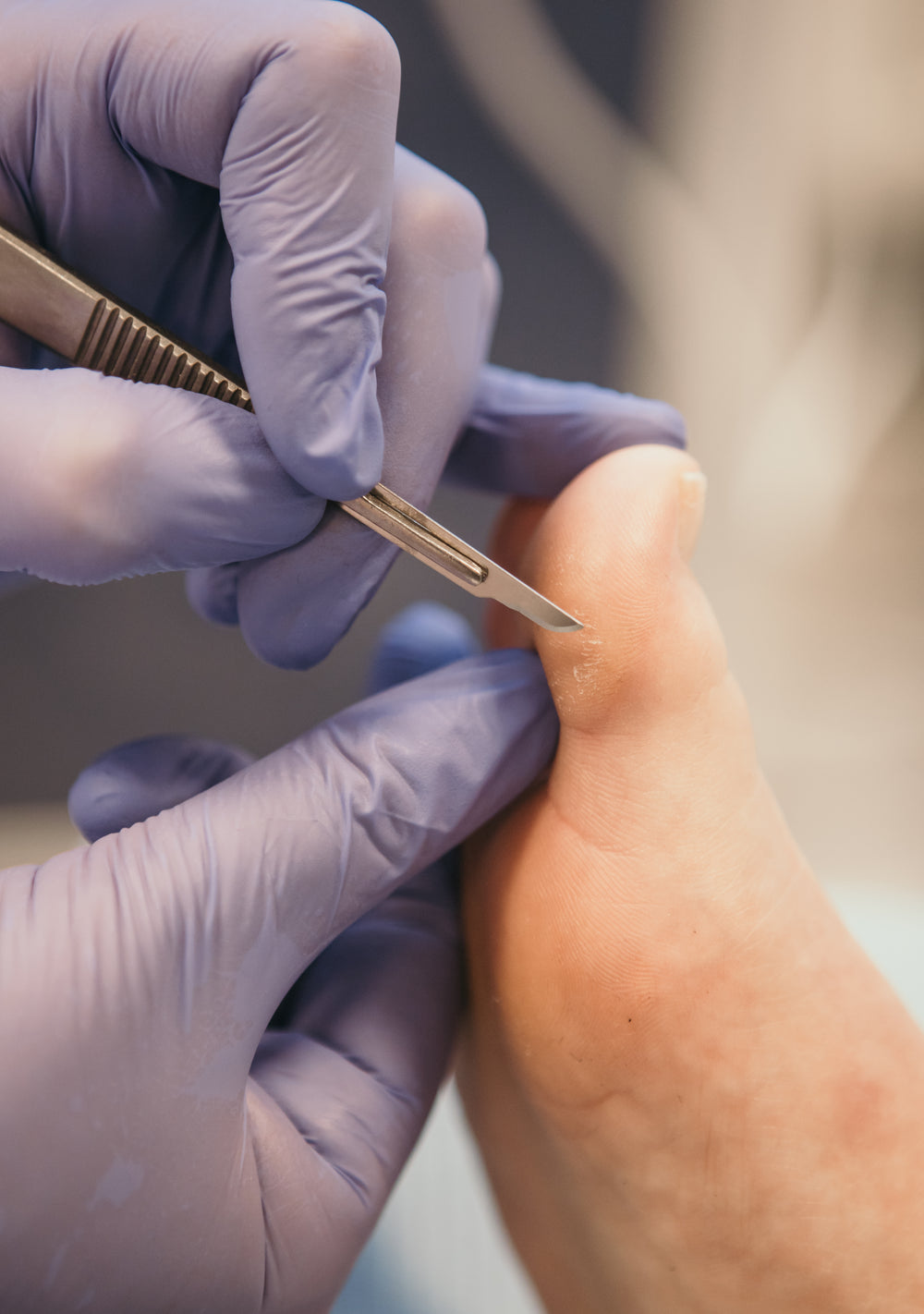 Callus Removal