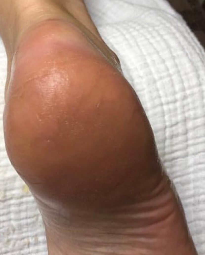 Why Imperial Feet Callus Softener