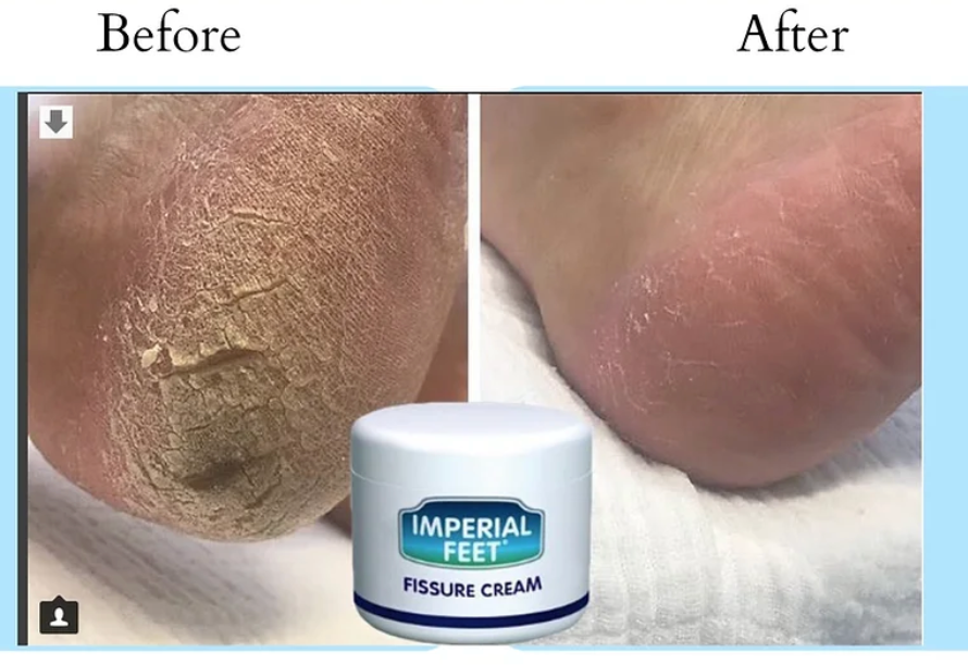 Why Foot Fissure Cream